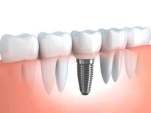 dentalimplants_img.jpg